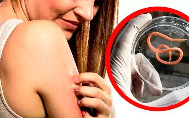 Gatal-gatal dan kerengsaan akibat parasit dalam badan