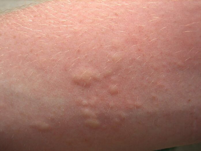Ruam alergi gatal boleh menjadi gejala ascariasis
